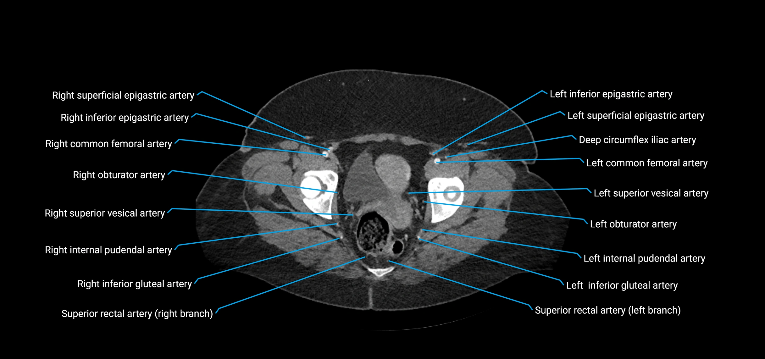 CTA abdomen axial cross sectional anatomy labelled image_236 (2).webp